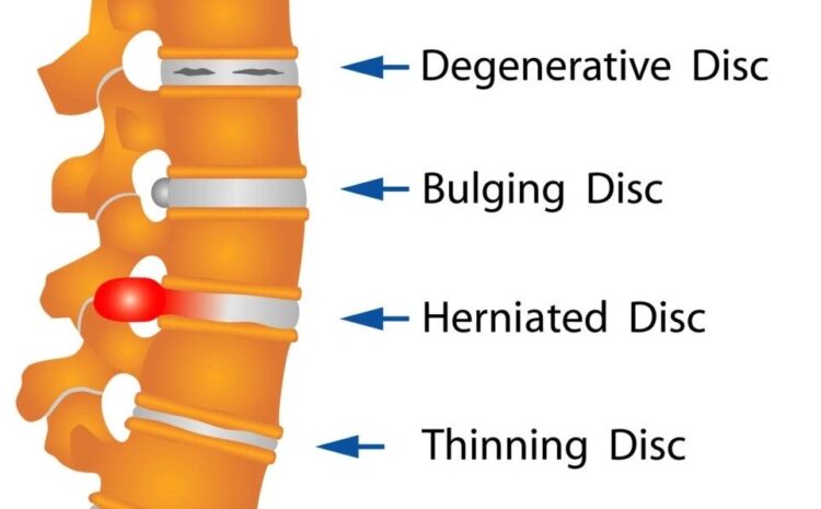  Common Soft Tissue Injuries: The Bulging Disc, vs Herniated