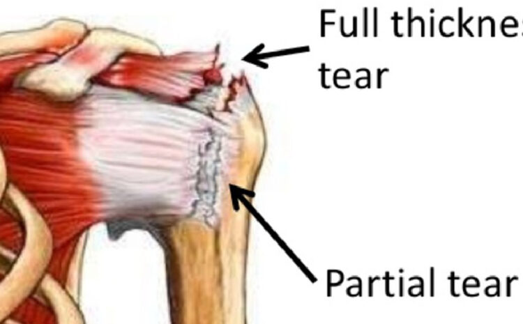  Personal Injury Law- Appellate Court Says Jury Award Too Low
